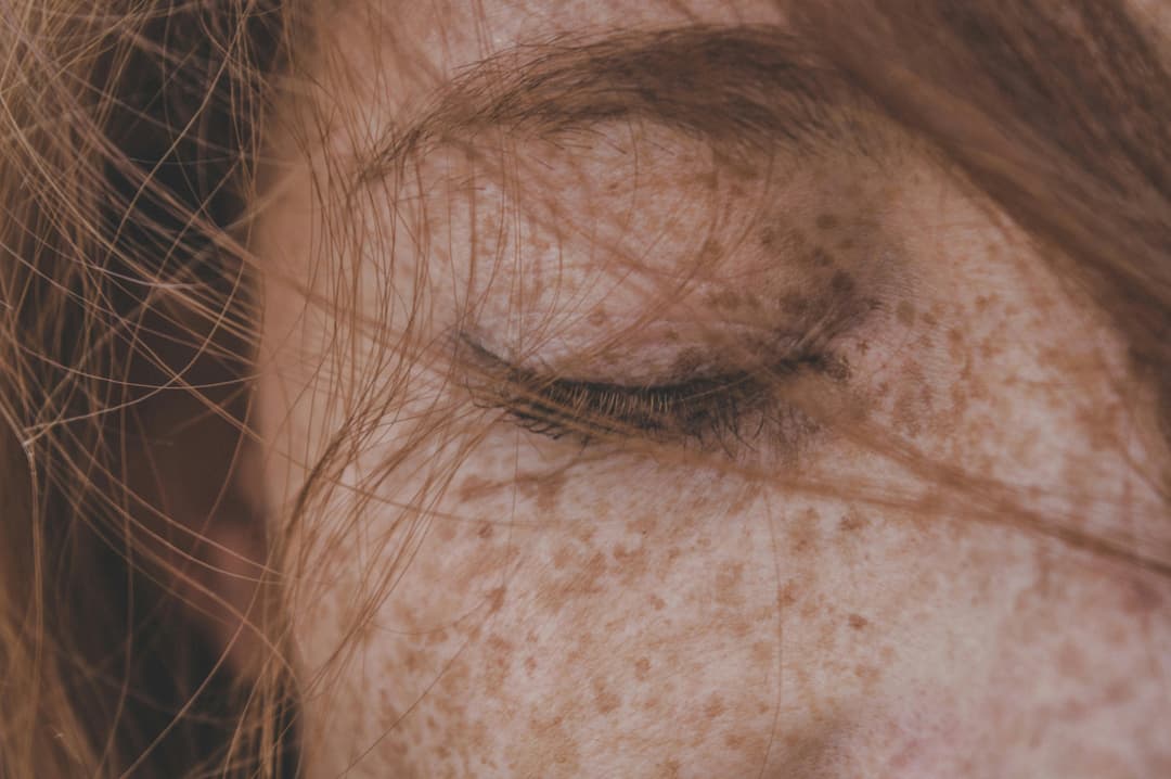 Freckles Removal