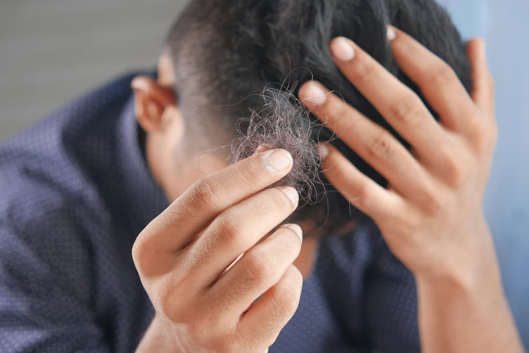 Hair Thinning
